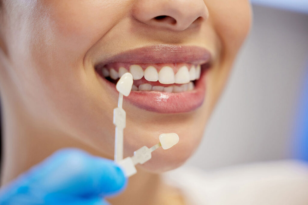Porcelain Veneers in Marietta, GA