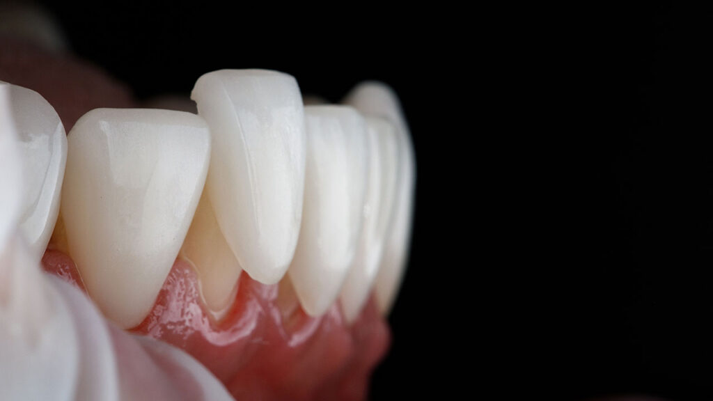 Veneers in Marietta, GA