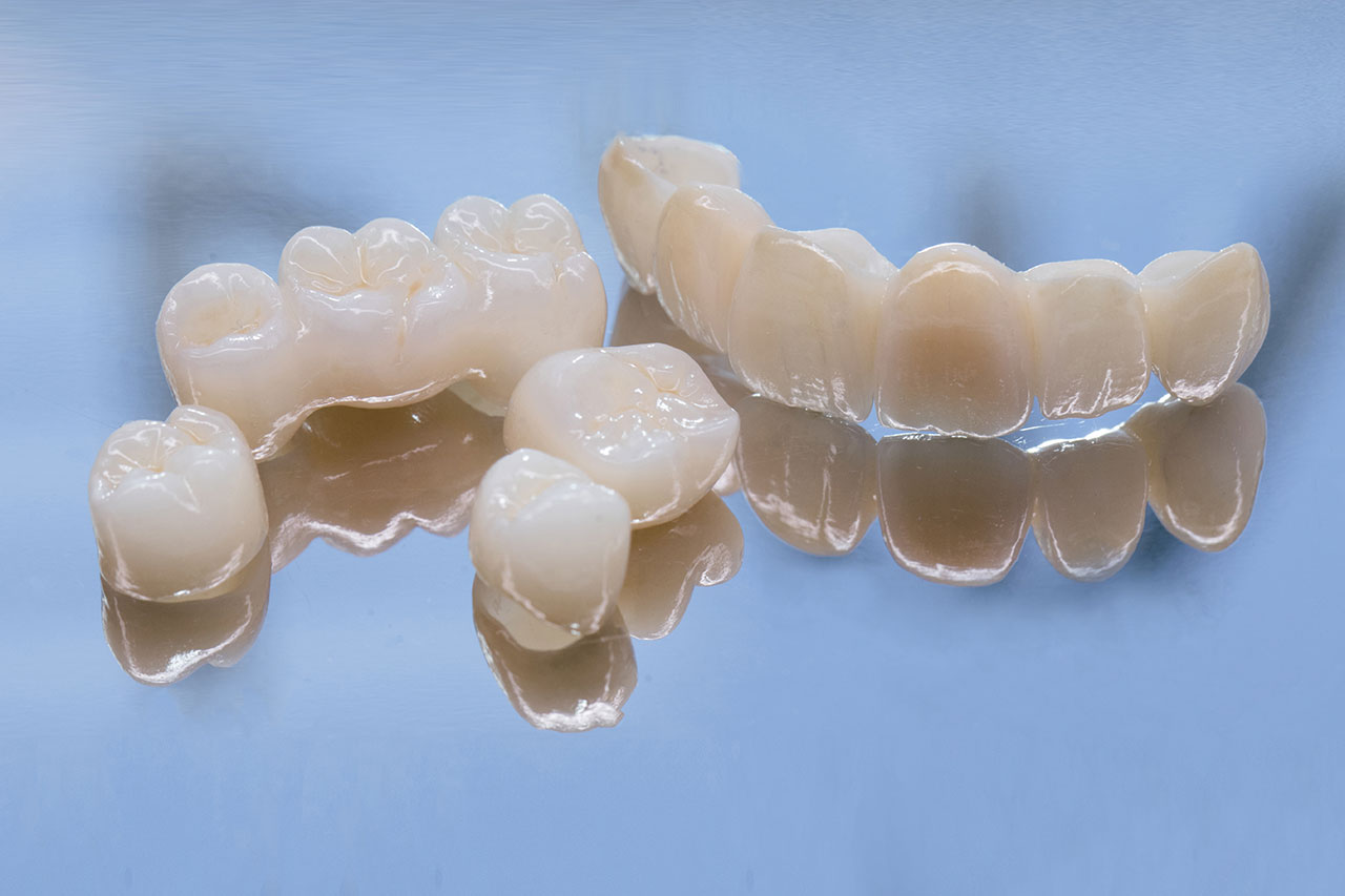 Dental Bridges: Fill the Gap, Protect Your Bite, Keep Life Moving