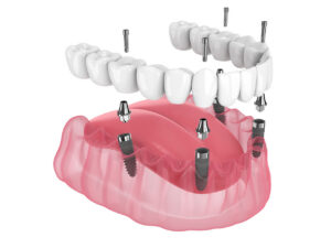 All-on-4 Dental Implants: A Secure Full-Arch Option for a New Smile Foundation