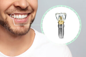 Single Tooth Dental Implants: A Strong Solution for One Missing Tooth