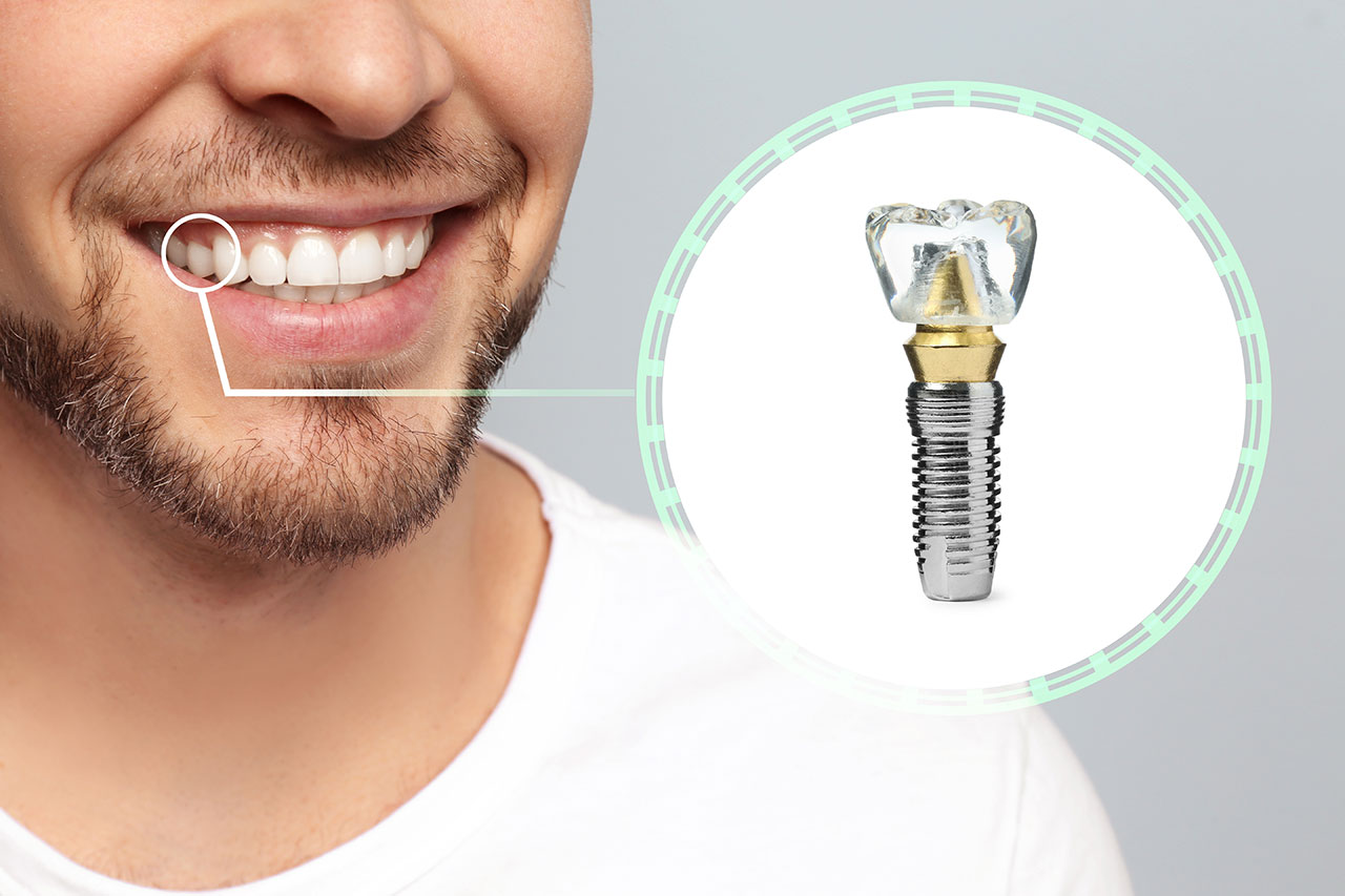 Single Tooth Dental Implants: A Strong Solution for One Missing Tooth