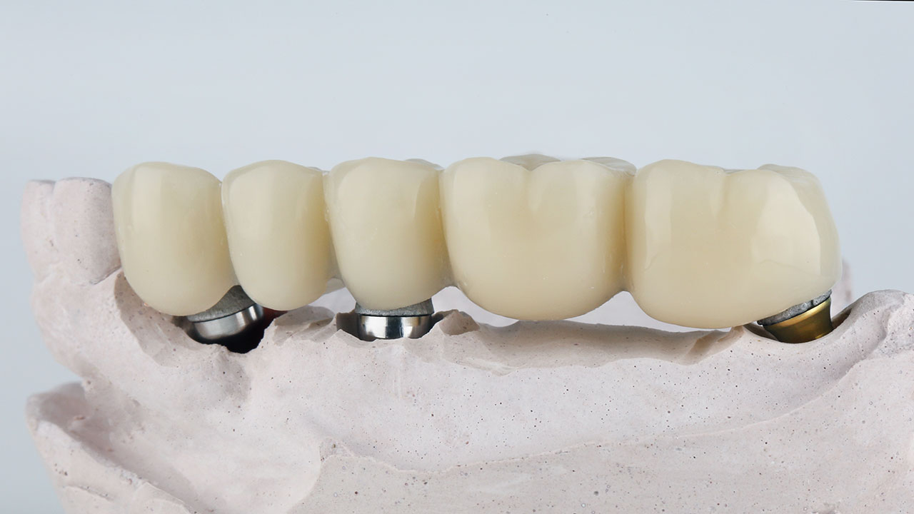 Implant Bridges: A Secure Way to Replace Several Missing Teeth