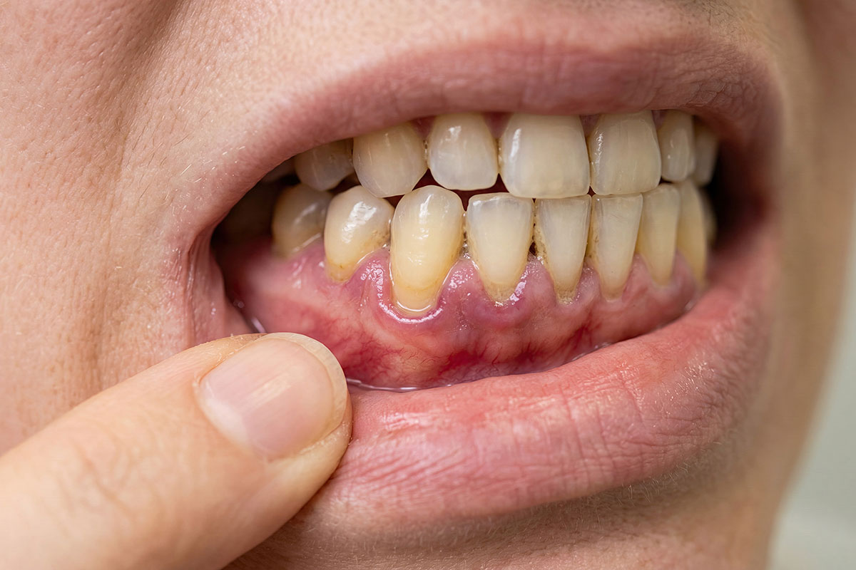 Diagnosing Periodontal Disease: How Early Answers Protect Your Smile